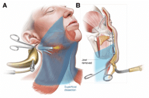 ponytail facelift